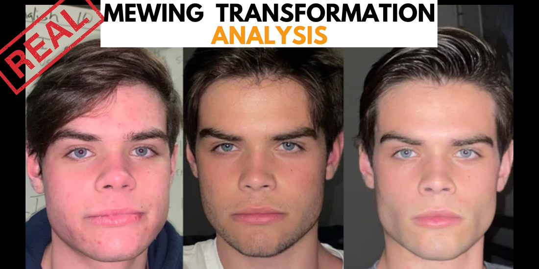 Before and after comparison of a 2-year mewing transformation showing noticeable facial structure improvements.