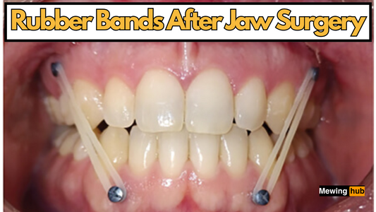 picture of teeth with rubber bands and text saying rubber bands after jaw surgery.