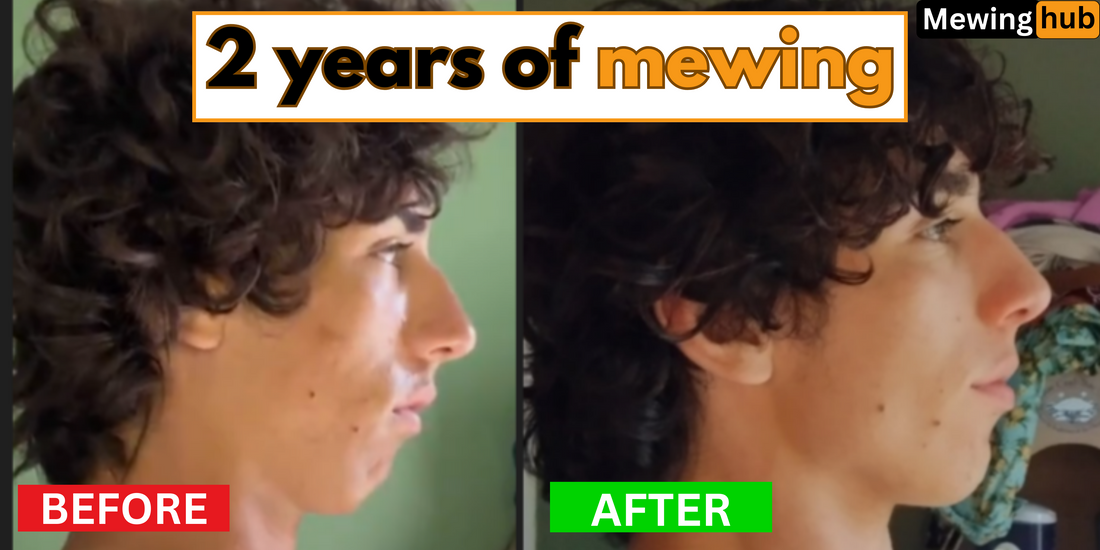 Side-by-side comparison of a man's facial profile before and after two years of mewing, showing improvements in facial symmetry, jawline definition, and overall facial structure.