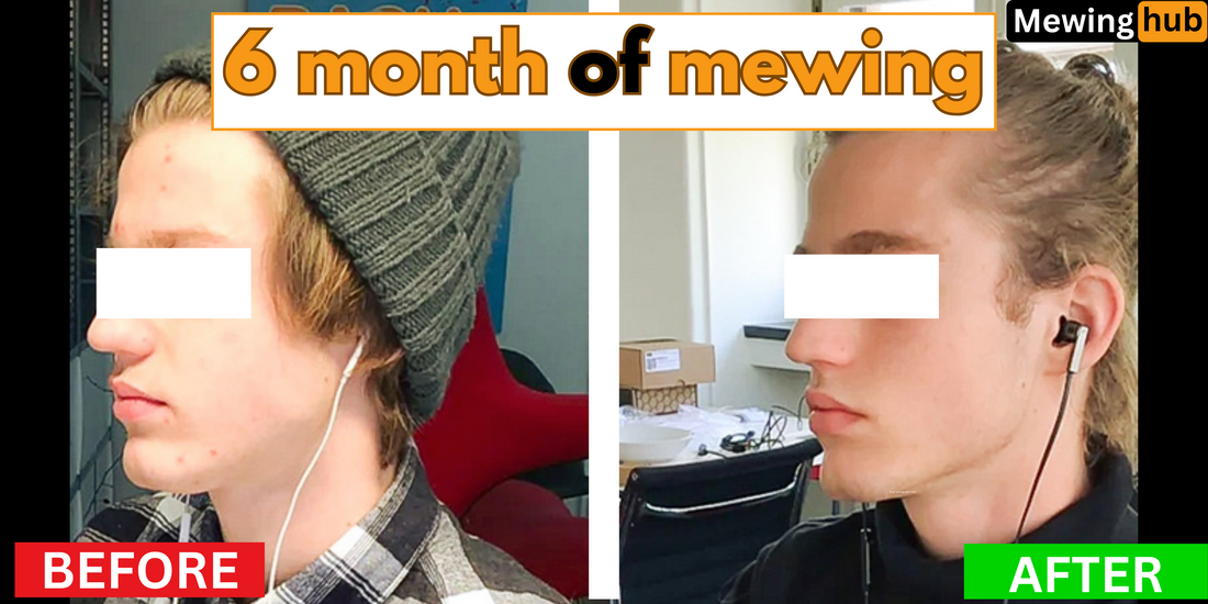 Before and after photos of a young male showing facial changes from 6 months of mewing practice.
