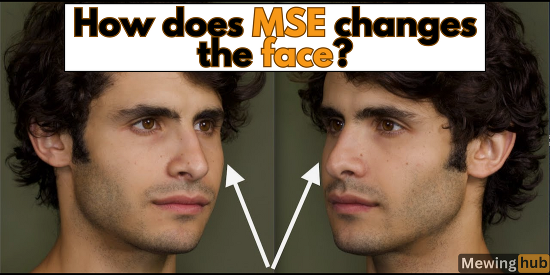 Before and after photos depicting facial changes due to MSE, illustrating increased jawline definition aswell as increased facial asymmetry