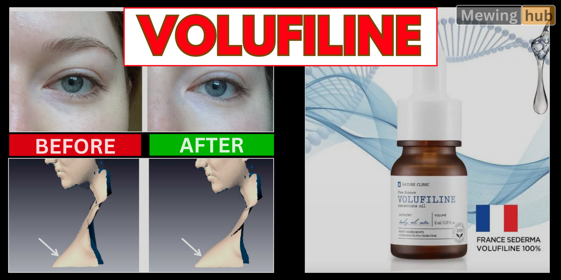 Side-by-side image showing before and after results of using Volufiline on a person's under-eye area, vosobly reducing dark circles.
