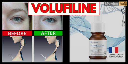 Side-by-side image showing before and after results of using Volufiline on a person's under-eye area, vosobly reducing dark circles.