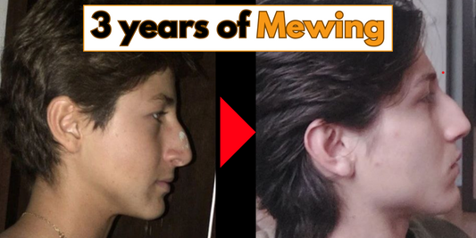 Side-by-side comparison of a man's face before and after three years of mewing, showing significant improvement in jawline definition, facial width, cheekbone prominence, and overall facial structure.