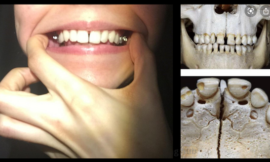 Images showing the midpalatal suture split.