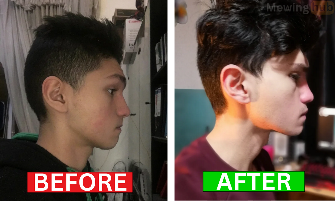 A side by side comparison, of an individual who did mewing for 3 years. Significant facial changes can be seen.