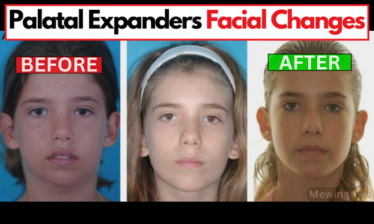 Before and after images of young patients demonstrating the facial changes from using palatal expanders, with noticeable enhancement in cheekbone width and facial balance.