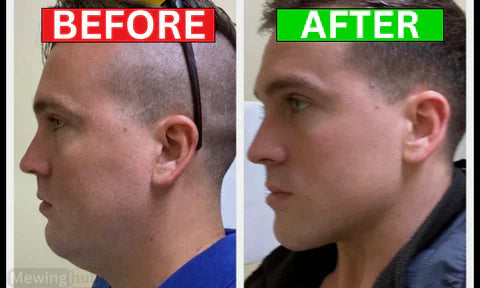 A before and after mewing transformation showing clear results.