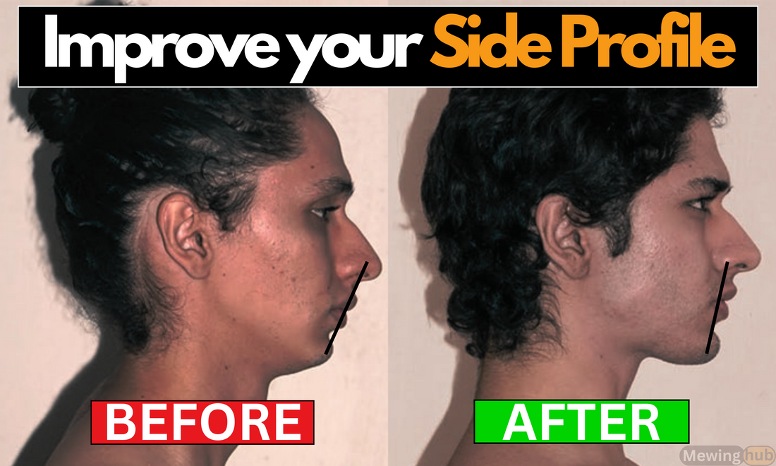 Before and after images showing enhanced side profile from mewing technique, demonstrating significant facial improvements.