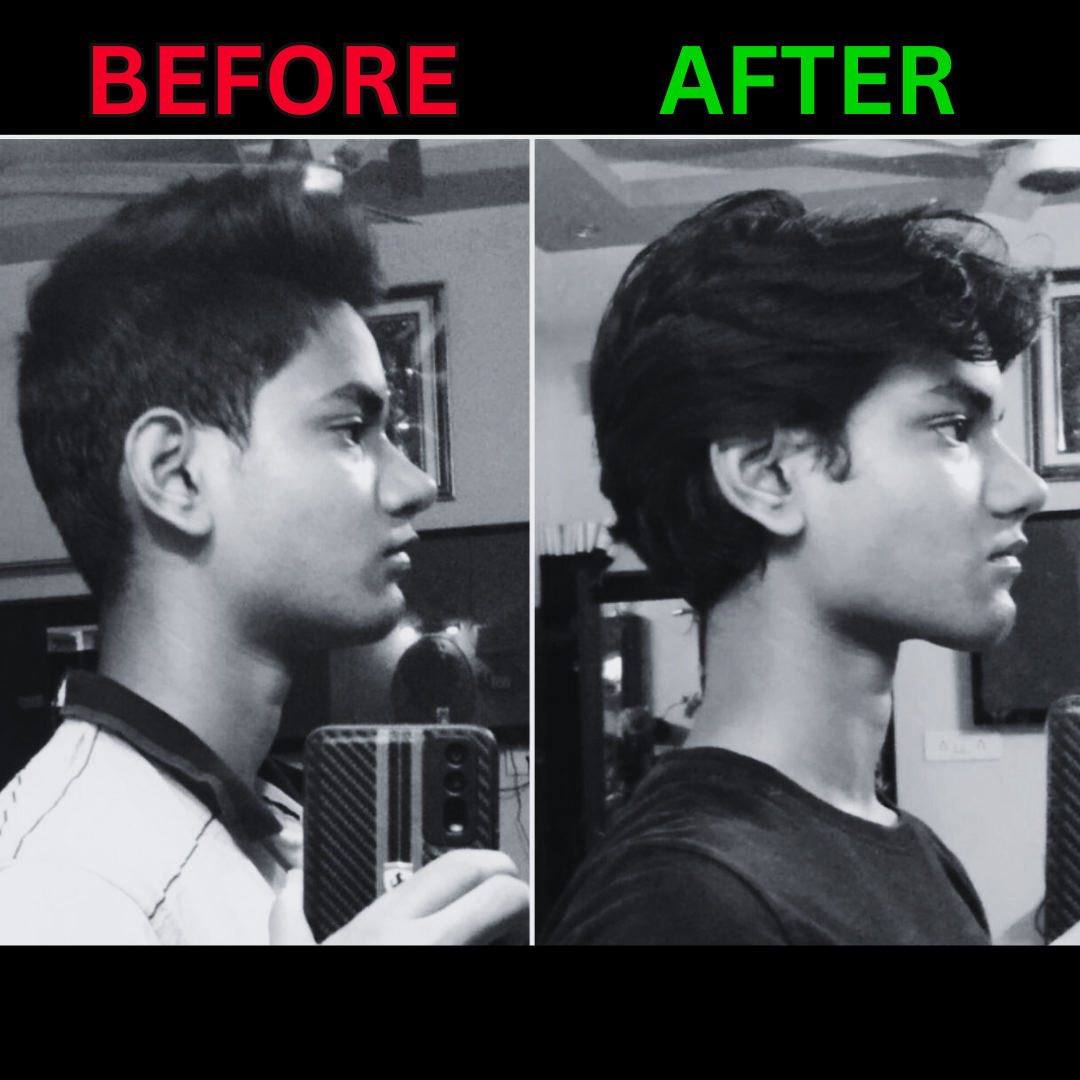 8 month before and after profile comparison showing remarkable jawline and facial changes due to mewing.