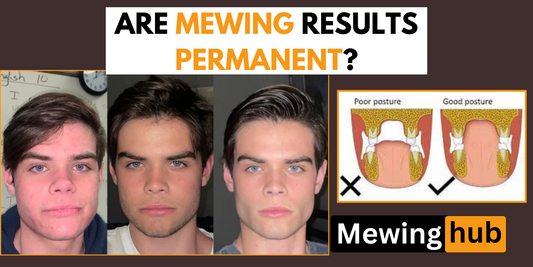 Side-by-side facial comparison and dental posture diagrams illustrating long-term mewing results.