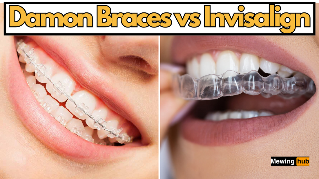 pictures of damon braces and invisalign with text saying damon braces vs invisalign