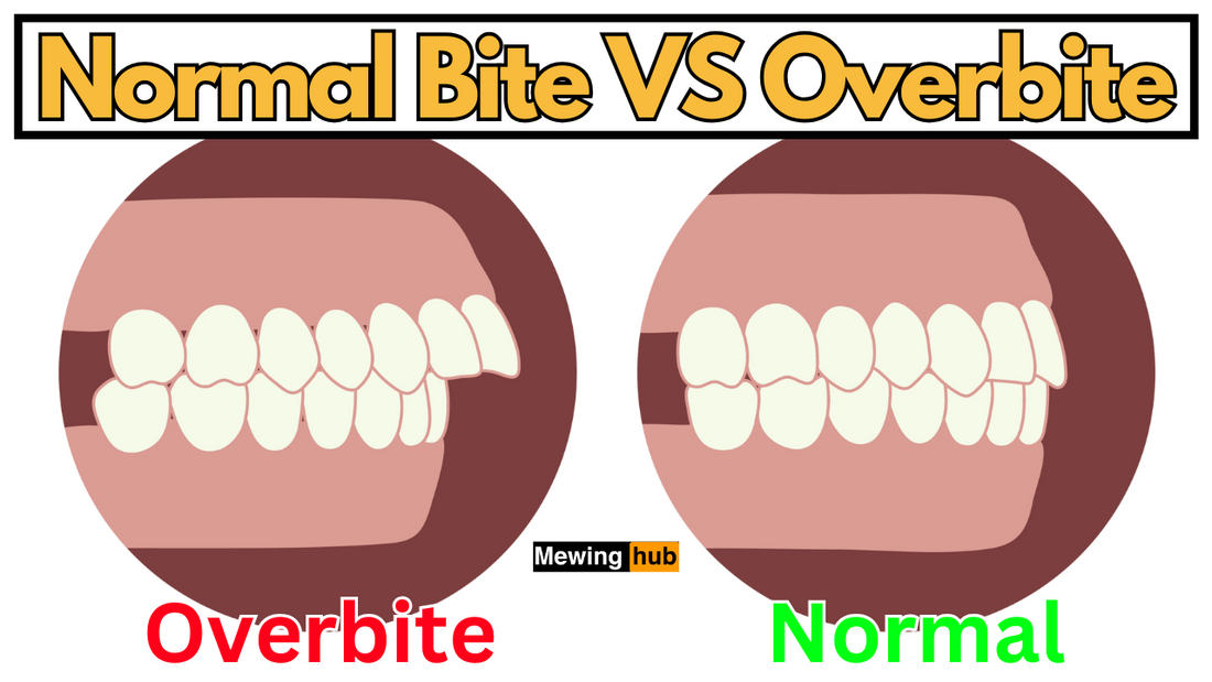 illustration image showing an overbite vs a normal bite with text saying normal bite vs overbite