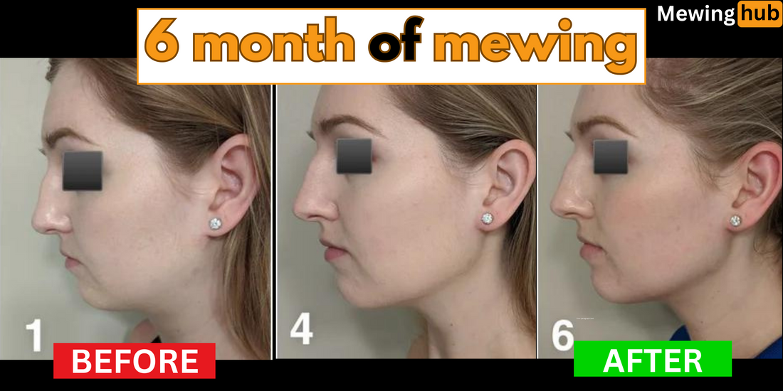 Side-by-side comparison of a woman's facial profile before and after six months of mewing, highlighting changes in jawline definition, cheekbone prominence, and overall facial structure.