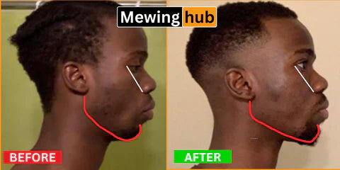 Amazing 1 year Before & After Mewing Transformation