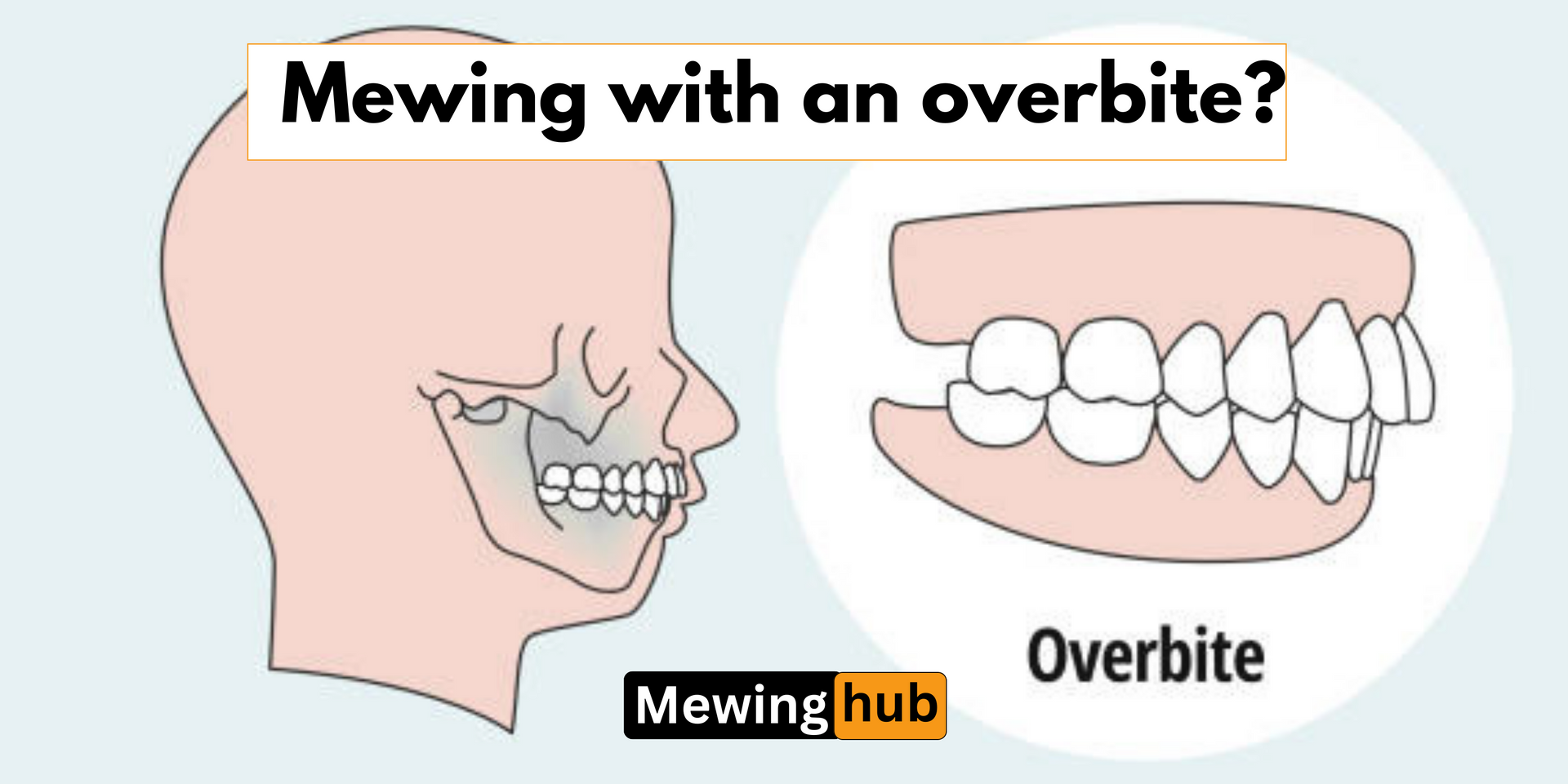 Mewing Appliance - A Device to Improve Your Facial Appearance