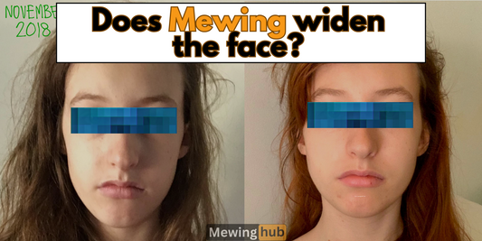 Comparison image of facial changes after 8 months of mewing showing widened facial features.