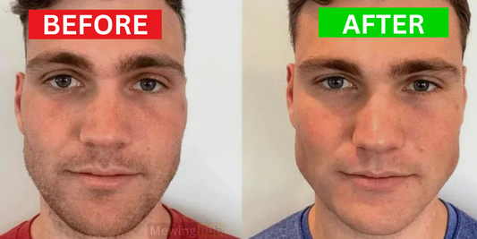 A before and after transformation from a chisell client, showing jawline growth. 