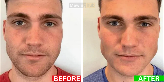 Before and after photos of a man showcasing the results of jawline enhancement exercises, highlighting noticeable improvements in jawline definition and facial symmetry.