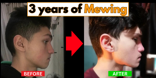 Side-by-side comparison of a man's facial profile before and after three years of mewing, showing significant improvements in jawline definition, facial symmetry, and overall facial structure.