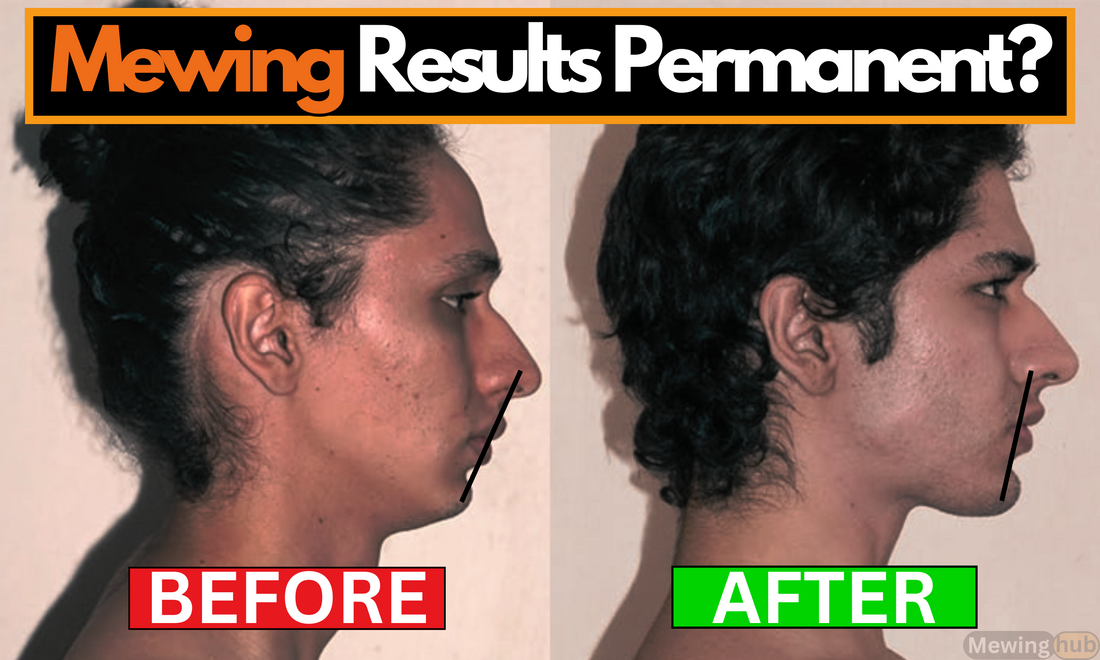 before and after mewing results