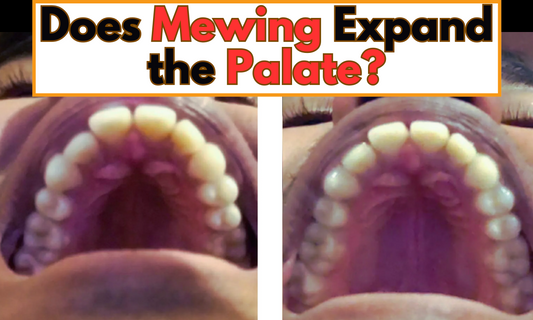 Image showing results from mewing in expanding the palate