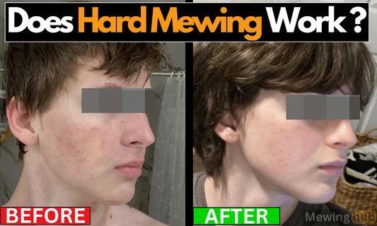 Before and after photos demonstrating changes from hard mewing, with noticeable jawline enhancement.