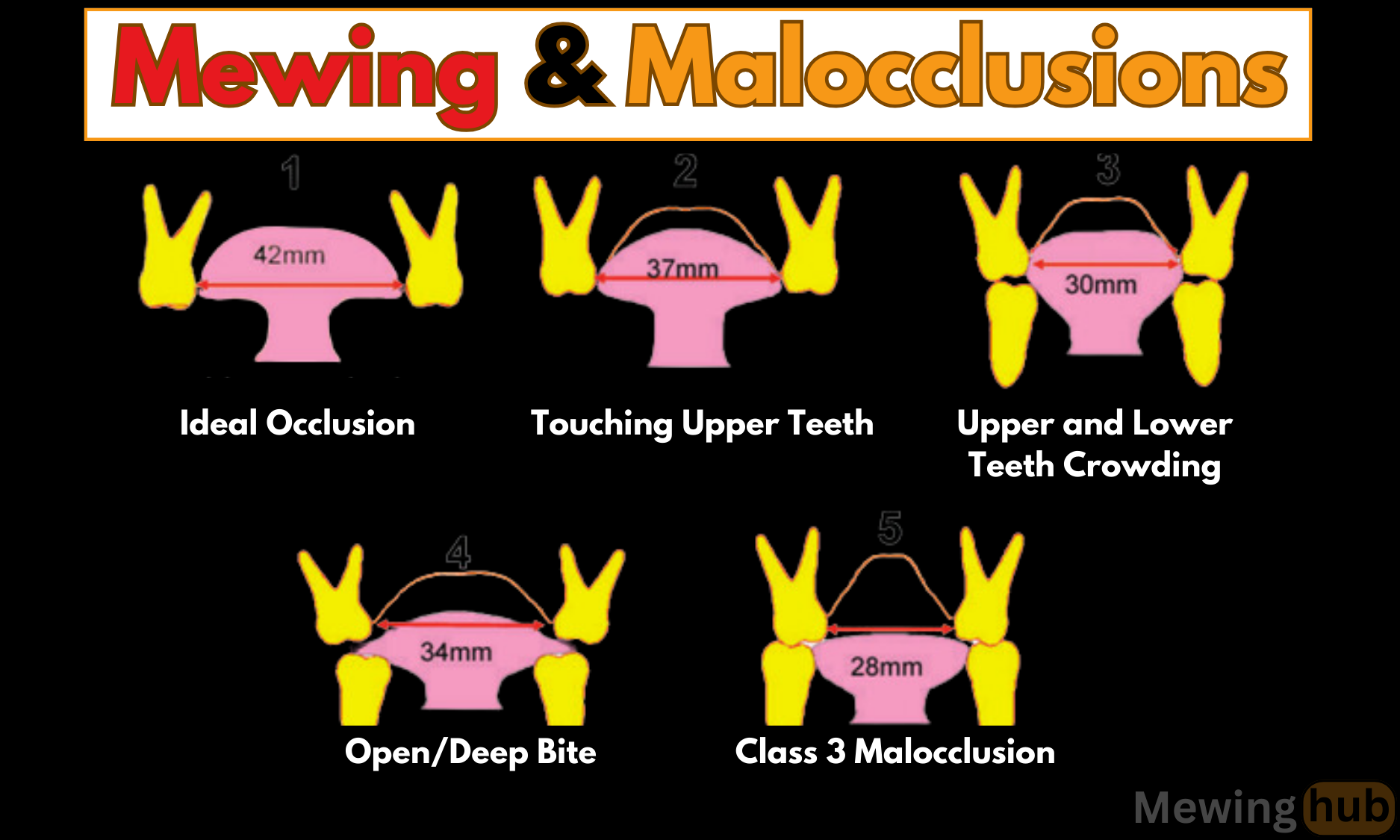 Mewing and Malocclusions Mewinghub