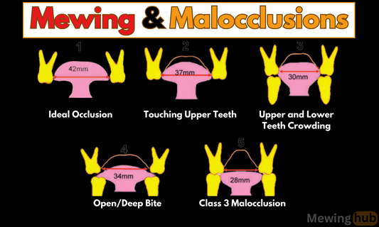 An Image demonstrating the connection between Tongue posture and malocclusions, showing the different types of malocclusions.