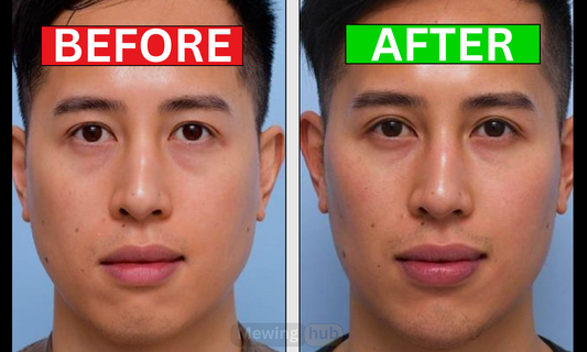 Before and after photos of a man’s face showing changes post-wisdom teeth removal.