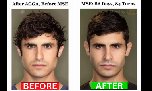 A before and after Image of an MSE candidate showing the facial changes attributed from the treatment.