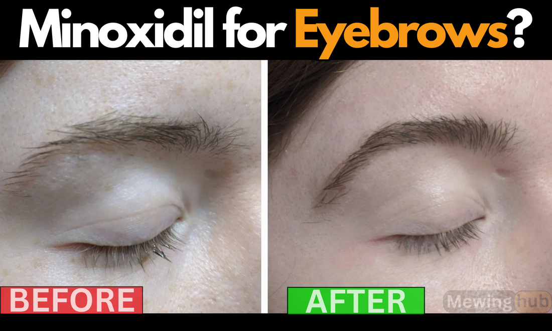Before and after comparison of eyebrow growth using Minoxidil, showcasing significant improvements in density and fullness.