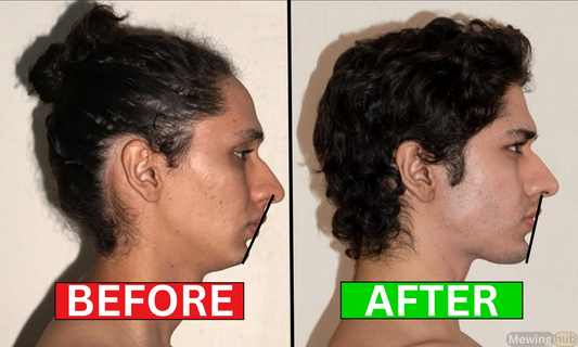 Profile comparison of a young man before and after one year of mewing, showing significant chin advancement.