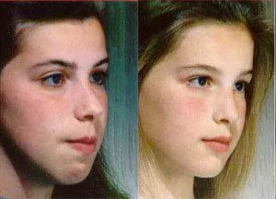 Before and after side profile comparison of a young female, illustrating the significant impact of mewing practices on jawline and facial symmetry.