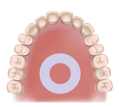 The Mewing Ring